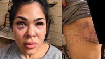 Rachael Ostovich muestra sus heridas tras la agresión de su marido