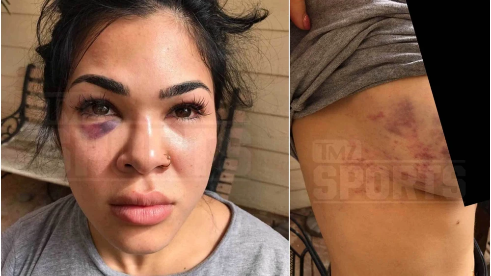 Rachael Ostovich muestra sus heridas tras la agresión de su marido