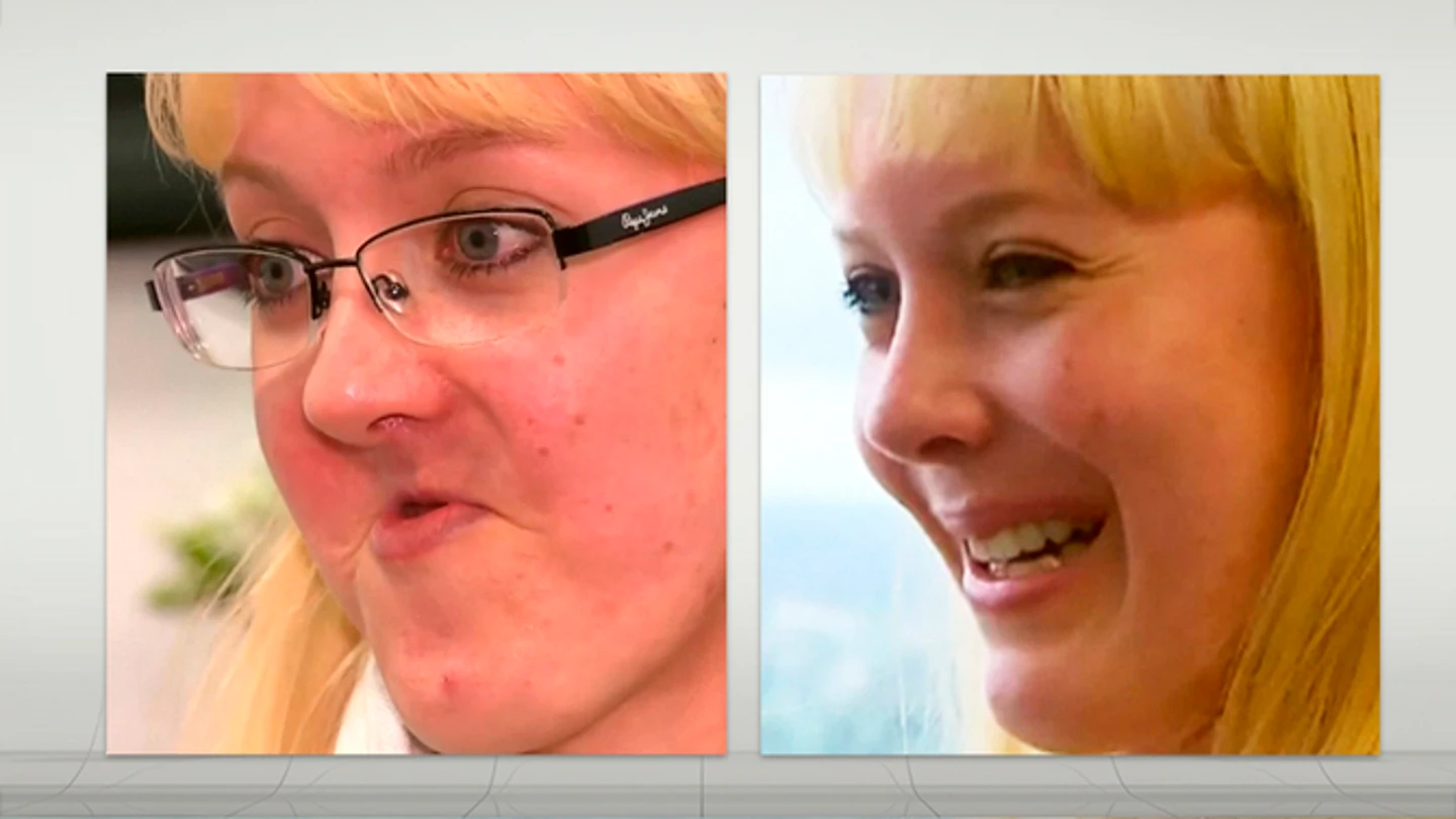 Anelia Myburgh antes y después de la operación Anelia Myburgh antes y después de la operación