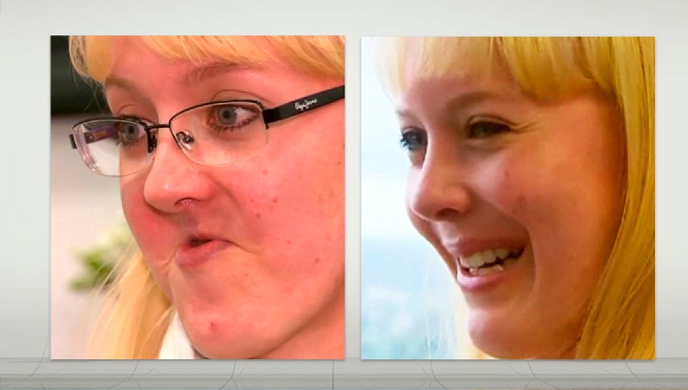 Anelia Myburgh antes y después de la operación