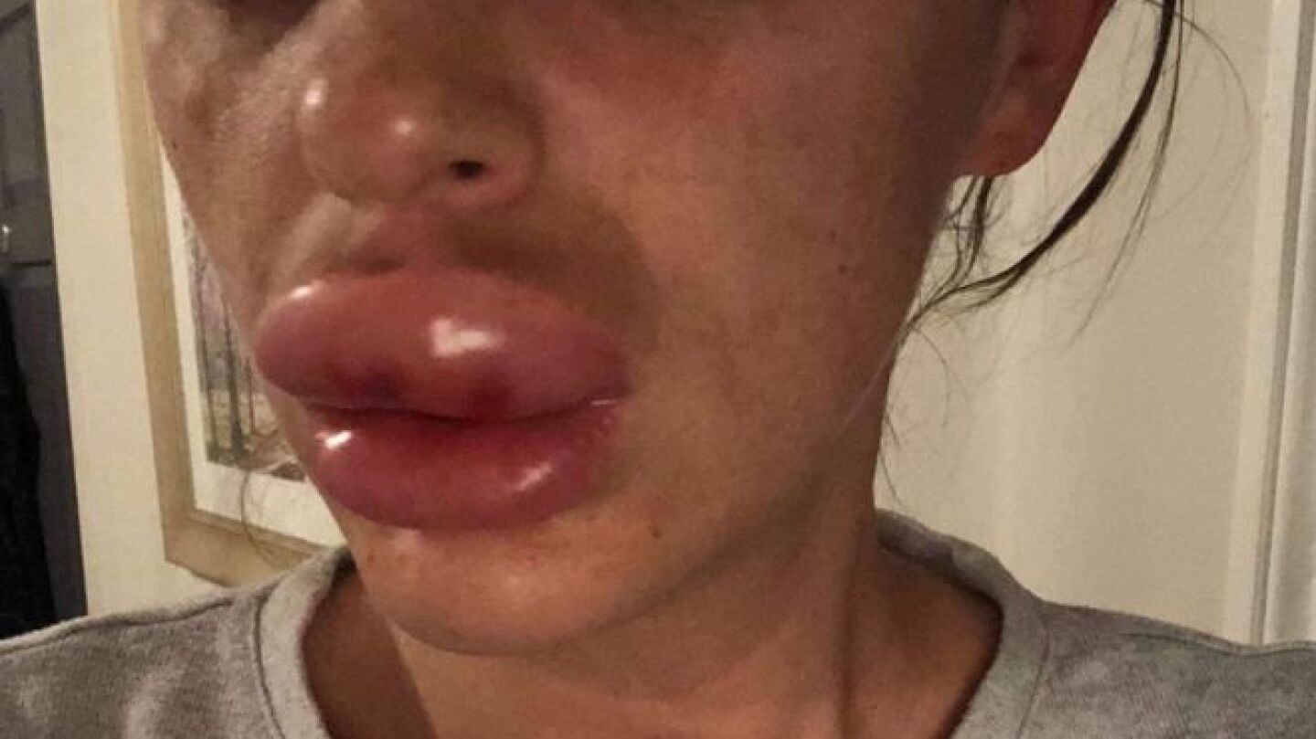 Imagen de c&oacute;mo qued&oacute; una mujer tras inyectarse b&oacute;tox