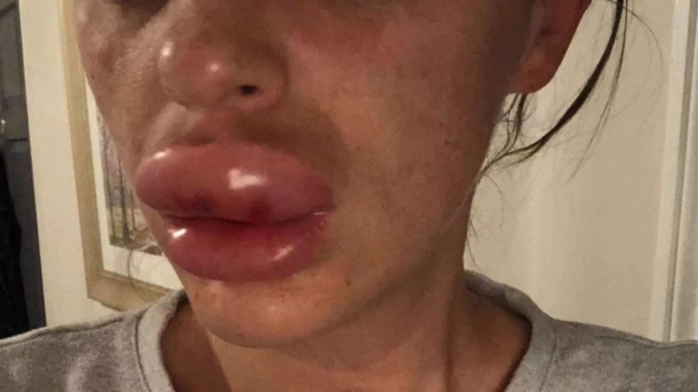 Imagen de cómo quedó una mujer tras inyectarse bótox Imagen de cómo quedó una mujer tras inyectarse bótox