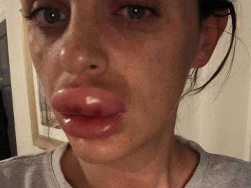 Imagen de cómo quedó una mujer tras inyectarse bótox Imagen de cómo quedó una mujer tras inyectarse bótox