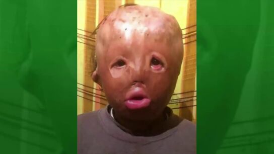 La desgarradora carta a Papa Noel de un ni&ntilde;o con la cara completamente quemada: "S&oacute;lo quiero ser como los dem&aacute;s"