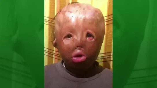 La desgarradora carta a Papa Noel de un niño con la cara completamente quemada: "Sólo quiero ser como los demás" La desgarradora carta a Papa Noel de un niño con la cara completamente quemada: "Sólo quiero ser como los demás"