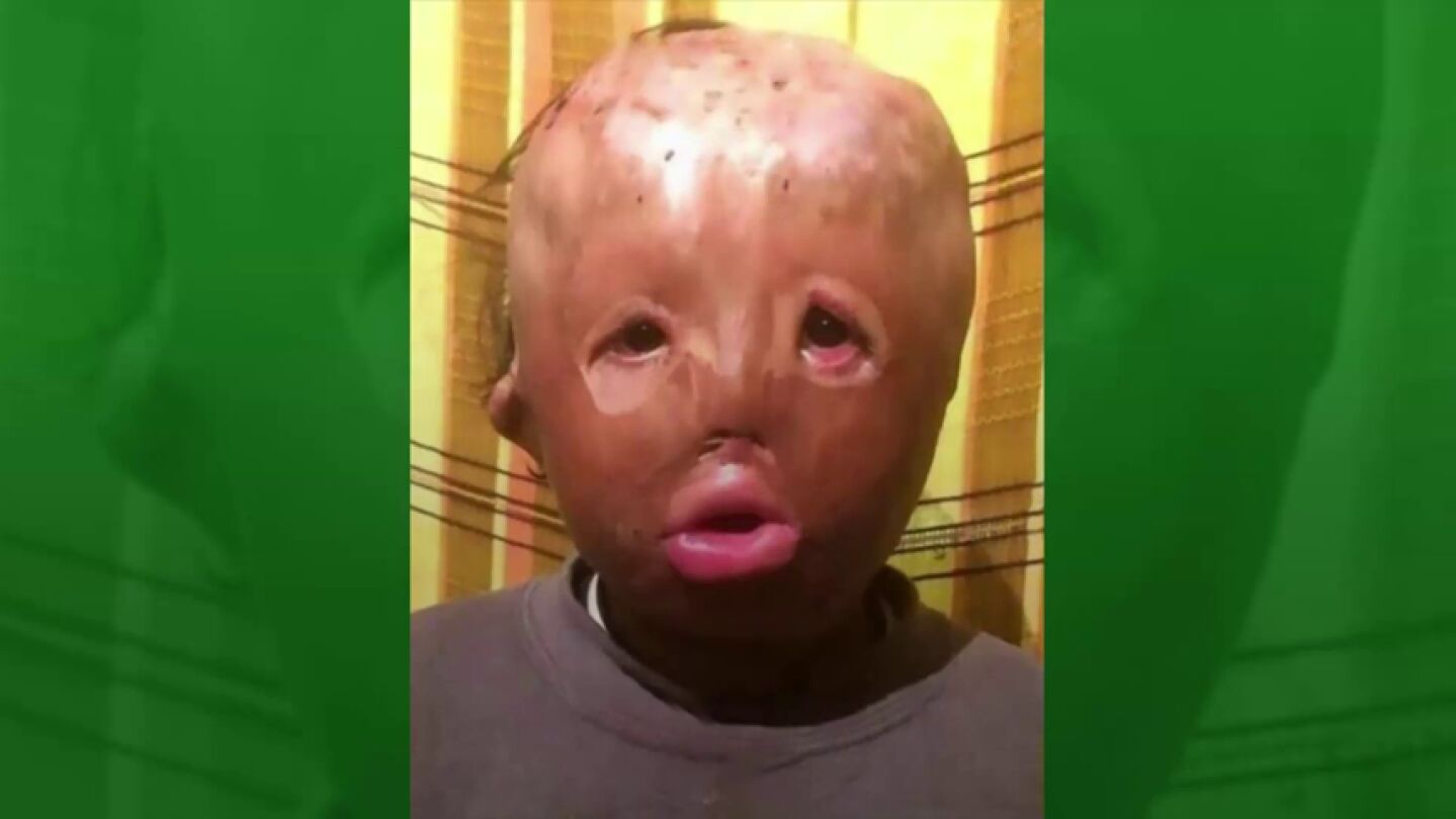 La desgarradora carta a Papa Noel de un ni&ntilde;o con la cara completamente quemada: "S&oacute;lo quiero ser como los dem&aacute;s"