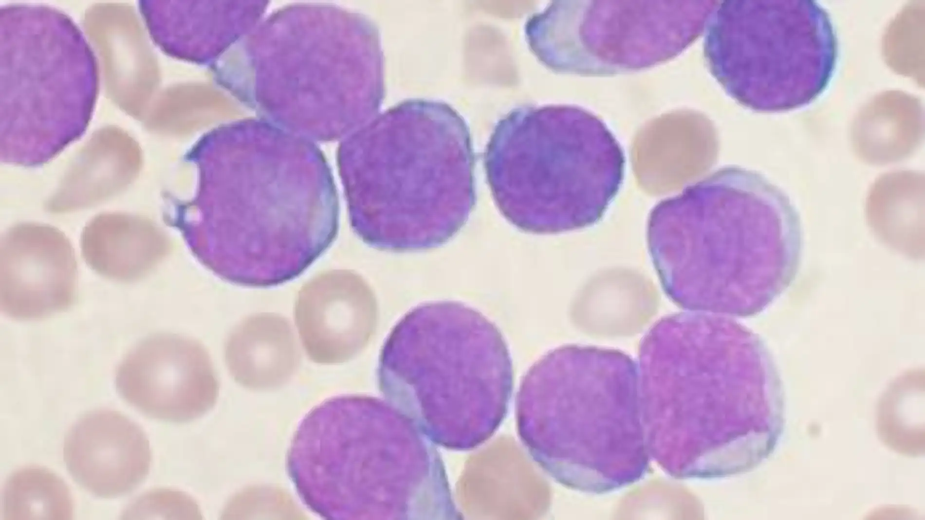 leucemia linfoide aguda