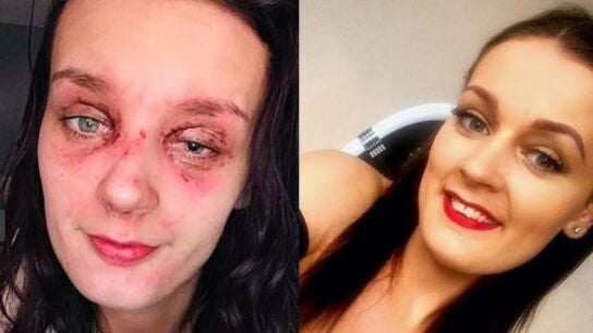 La joven con quemaduras en el ojo