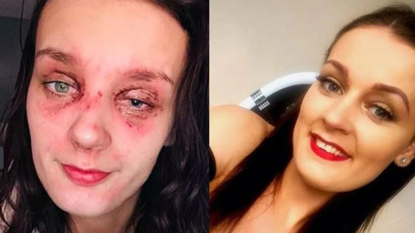 La joven con quemaduras en el ojo La joven con quemaduras en el ojo