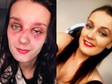 La joven con quemaduras en el ojo La joven con quemaduras en el ojo