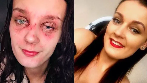 La joven con quemaduras en el ojo La joven con quemaduras en el ojo