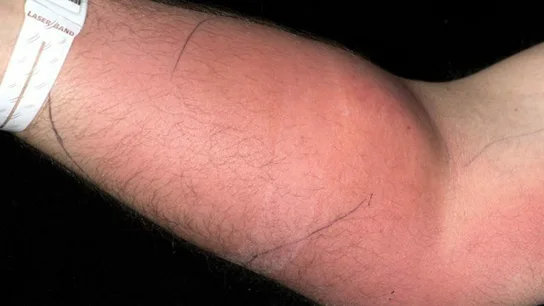 Inyección de semen en el antebrazo Inyección de semen en el antebrazo