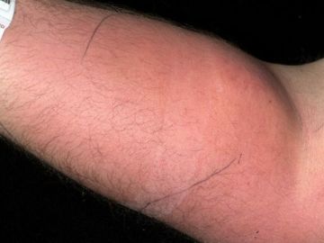 Inyección de semen en el antebrazo Inyección de semen en el antebrazo