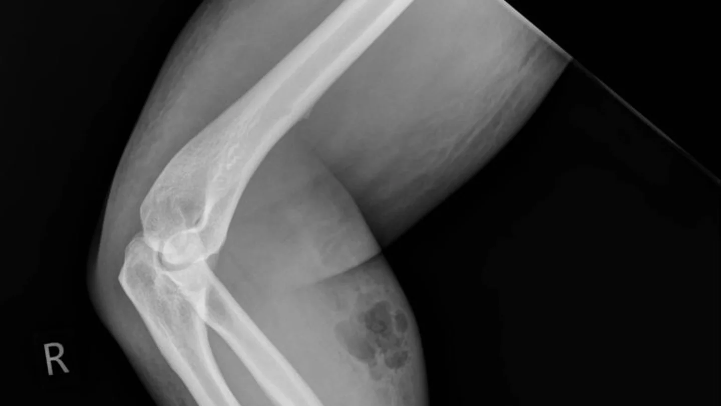 Hospitalizado por inyectarse semen en el antebrazo Hospitalizado por inyectarse semen en el antebrazo