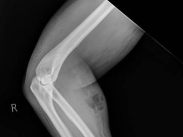 Hospitalizado por inyectarse semen en el antebrazo Hospitalizado por inyectarse semen en el antebrazo