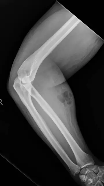 Hospitalizado por inyectarse semen en el antebrazo Hospitalizado por inyectarse semen en el antebrazo