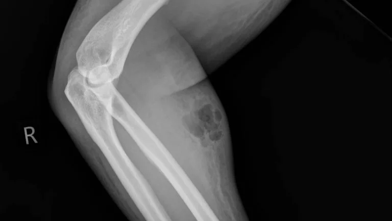 Hospitalizado por inyectarse semen en el antebrazo Hospitalizado por inyectarse semen en el antebrazo