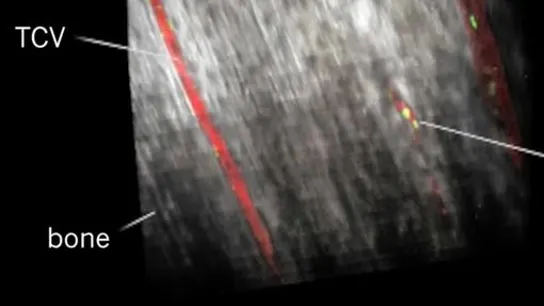 Los vasos transcorticales que se han descubierto en los huesos. Los vasos transcorticales que se han descubierto en los huesos.