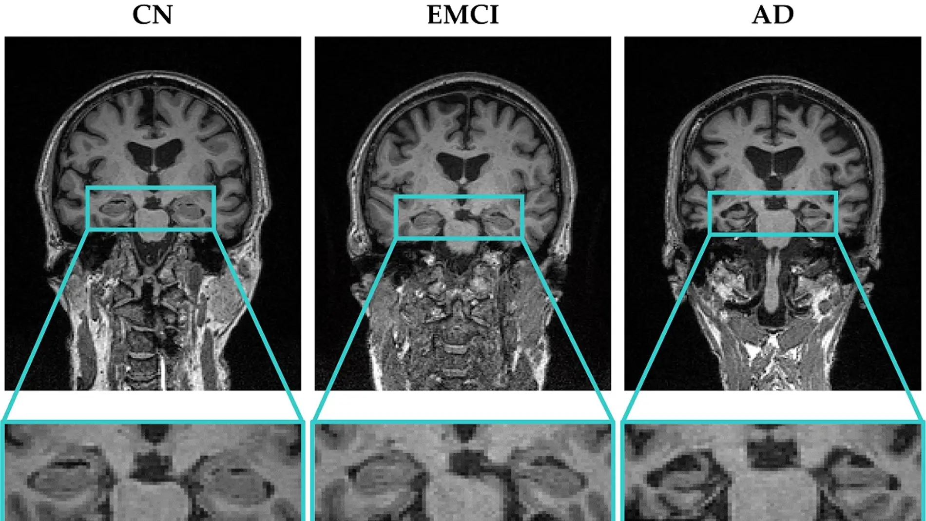 Nueva herramienta para ayudar a la deteccion precoz del alzheimer