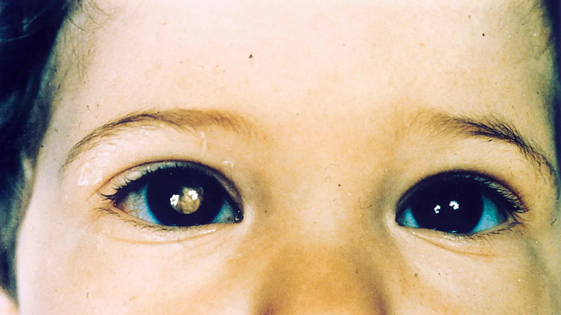 Niño con retinoblastoma