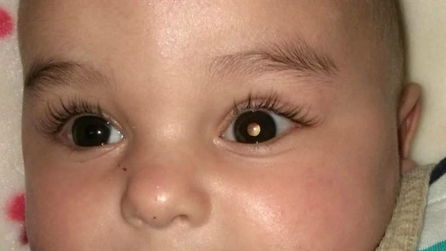 Bebé con cáncer de retina. Bebé con cáncer de retina.