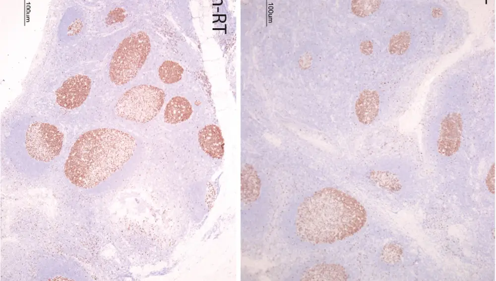 Las amígdalas de los niños que sufrían amigdalitis (derecha) tienen menos desarrollados los centros germinales