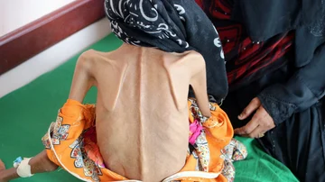 Fatima Qoba en una clínica de desnutrición