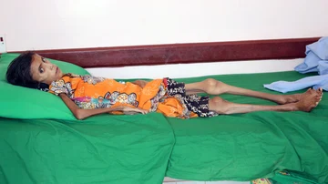 Fatima Qoba en una clínica de desnutrición