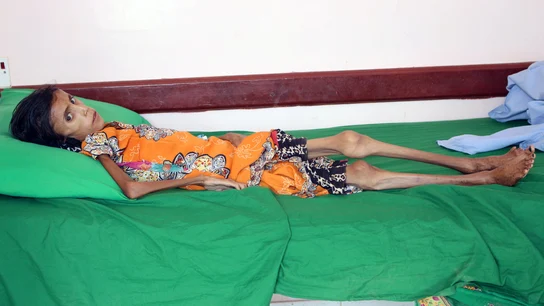 Fatima Qoba en una clínica de desnutrición Fatima Qoba en una clínica de desnutrición