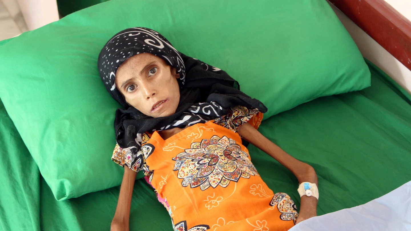 Fatima, con 12 años, sólo pesa 10 kilos Fatima, con 12 años, sólo pesa 10 kilos