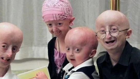 Hallan una terapia contra la progeria, la enfermedad que envejece a los niños Varios pacientes con progeria