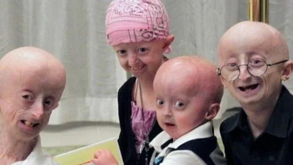 Varios pacientes con progeria