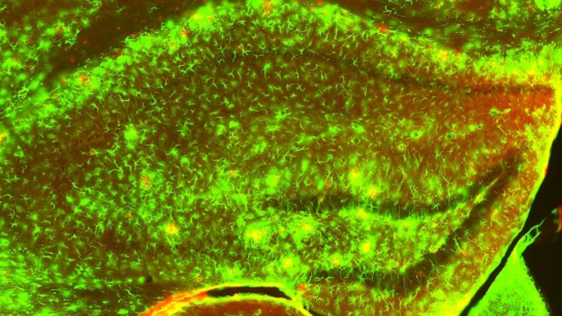 astrocitos reactivos en las zonas de patología