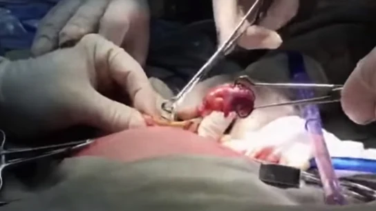 Operación para extraer el feto a la bebé Operación para extraer el feto a la bebé