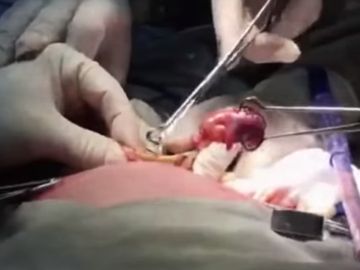 Operación para extraer el feto a la bebé Operación para extraer el feto a la bebé