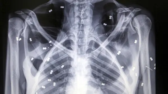 Radiografía que muestra la cantidad de perdigones que posee el primate. Radiografía que muestra la cantidad de perdigones que posee el primate.