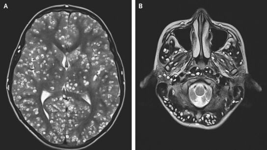 Cerebro del joven infectado con gusanos