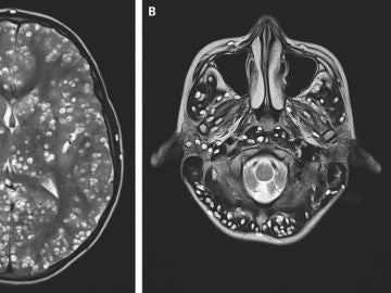 Cerebro del joven infectado con gusanos Cerebro del joven infectado con gusanos