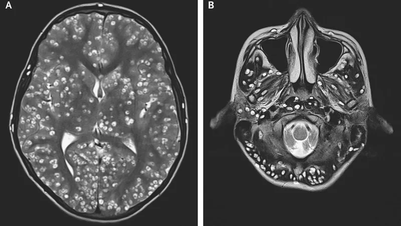 Cerebro del joven infectado con gusanos