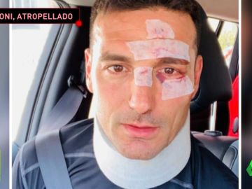 Un coche atropella al seleccionador argentino Lionel Scaloni cuando iba en bicicleta por Mallorca Un coche atropella al seleccionador argentino Lionel Scaloni cuando iba en bicicleta por Mallorca