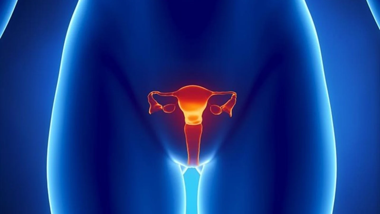 Cáncer de endometrio (Archivo) Cáncer de endometrio (Archivo)