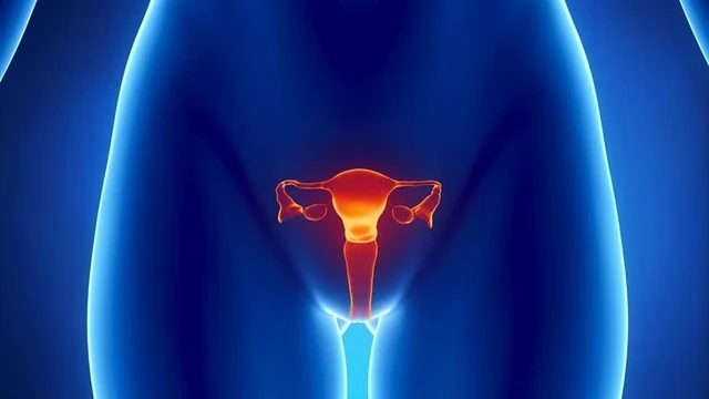 Cáncer de endometrio (Archivo)