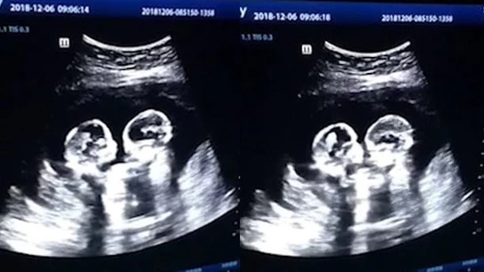 Ecografía de las dos gemelas 'peleándose' Ecografía de las dos gemelas 'peleándose'
