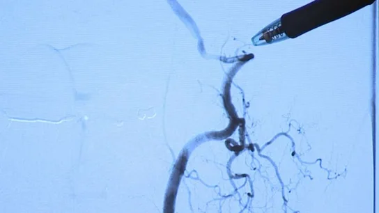 Imagen de la arteria dañada tras estirar el cuello Imagen de la arteria dañada tras estirar el cuello
