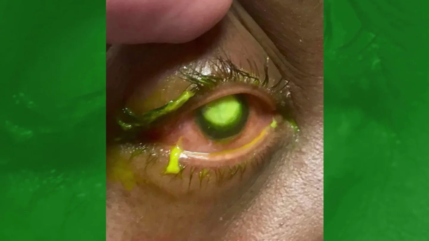 Un oftalmólogo alerta con unas impactantes fotografías de los riesgos de dormir con lentillas Un oftalmólogo alerta con unas impactantes fotografías de los riesgos de dormir con lentillas