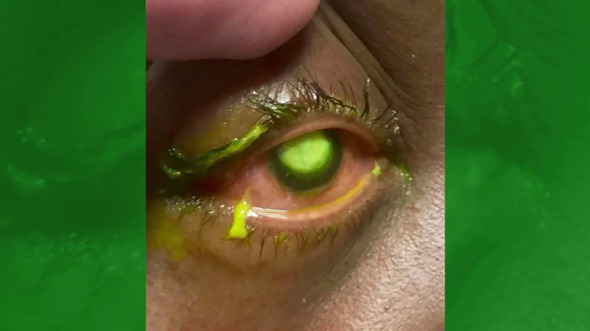 Un oftalmólogo alerta con unas impactantes fotografías de los riesgos de dormir con lentillas