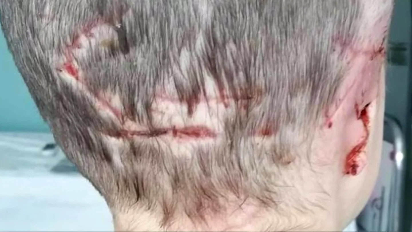 Una menor de cinco años ha perdido la oreja derecha después de sufrir el ataque de un labrador Una menor de cinco años ha perdido la oreja derecha después de sufrir el ataque de un labrador