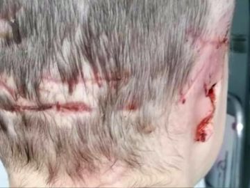 Una menor de cinco años ha perdido la oreja derecha después de sufrir el ataque de un labrador Una menor de cinco años ha perdido la oreja derecha después de sufrir el ataque de un labrador