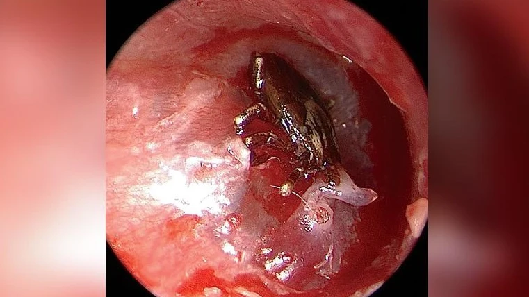 Imagen del tímpano del niño de nueve años con una garrapata Imagen del tímpano del niño de nueve años con una garrapata
