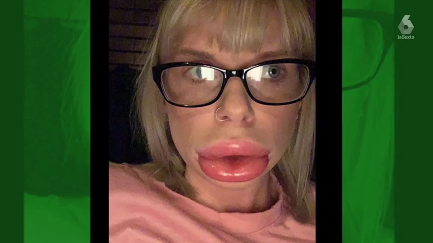Utiliza un tratamiento para agrandarse los labios y acaba con la boca desfigurada Utiliza un tratamiento para agrandarse los labios y acaba con la boca desfigurada